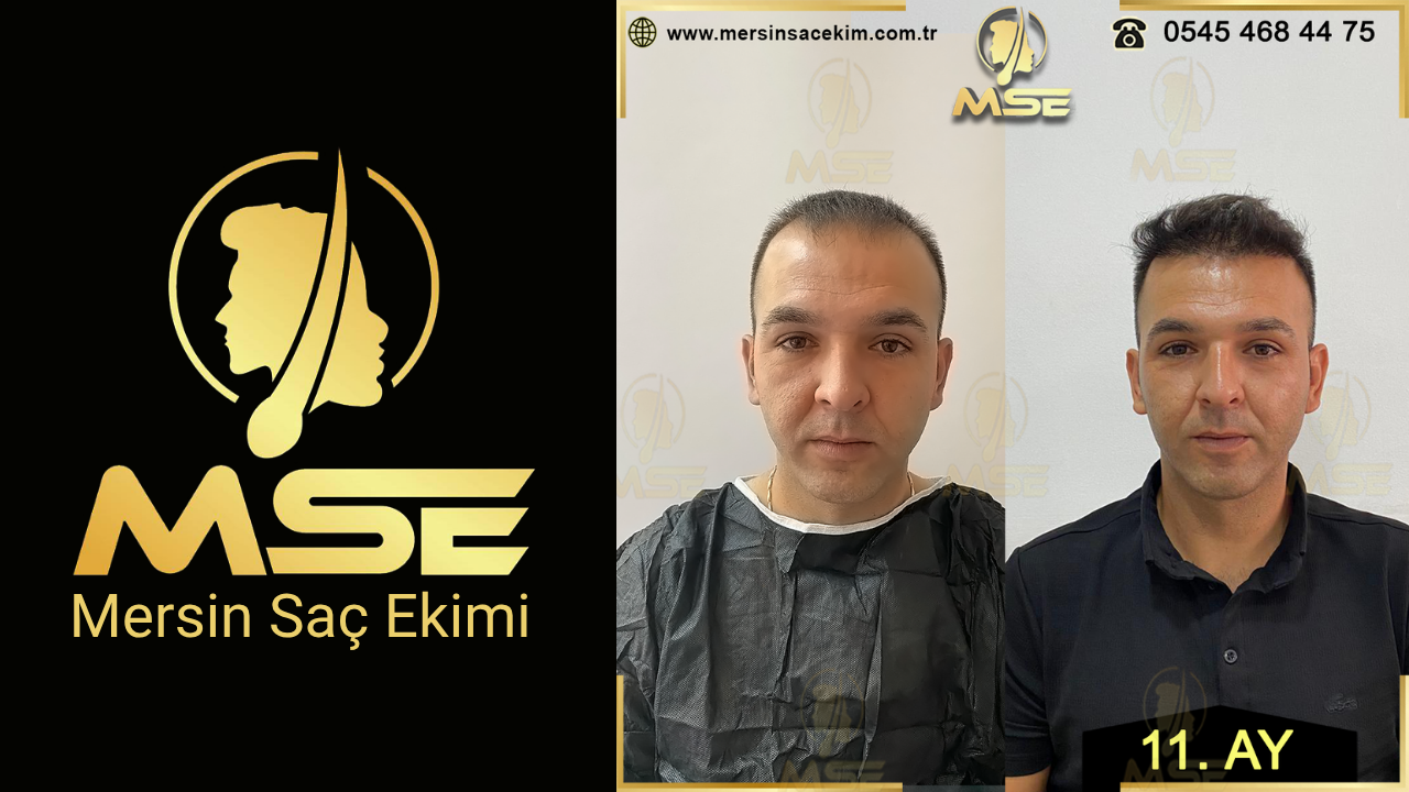 MERSİN SAÇ EKİMİ
